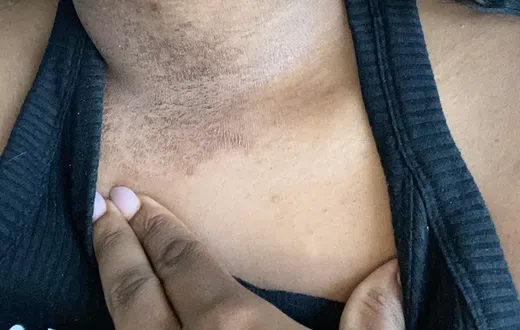 Jewellery rash