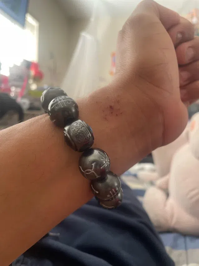 How to treat jewelry rash & prevent irritation: 6 solutions you need to know