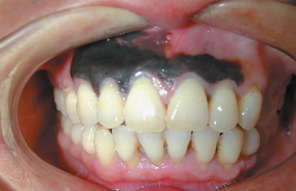 Hyper-pigmentation of the gums(NBC News)