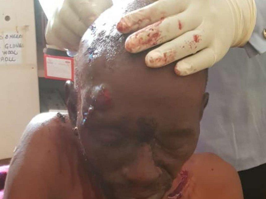 One of the casualties admitted in hospital after Moses Nandalwe forced his way into the venue of a fund raiser