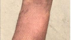 Bruises from the alleged police assault