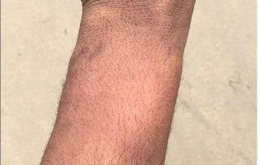 Bruises from the alleged police assault