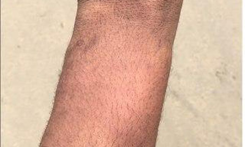 Bruises from the alleged police assault