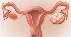 polycystic ovarian syndrome(Bayer Research Magazine)