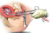 Unsafe abortions are rampant in Kenya