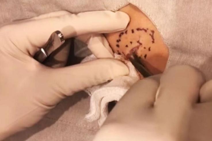 Dr. Pimple Popper's Latest Video Is Truly Vile