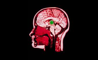 Doctors use electrical implant to aid brain-damaged woman