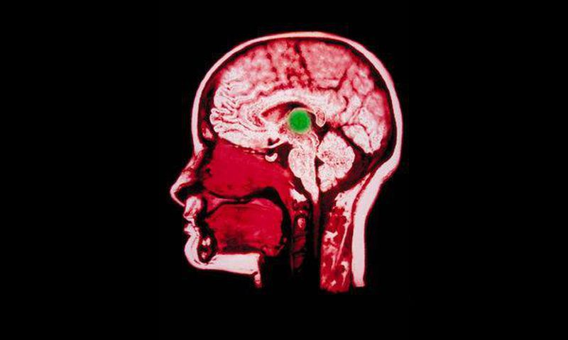 Doctors use electrical implant to aid brain-damaged woman