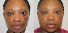 A blemished skin shows improvement after treatment
