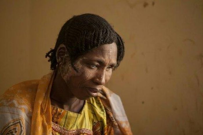 A woman receives medical care for burns following clashes between the Nigerian military and Boko Haram Islamists in Borno State