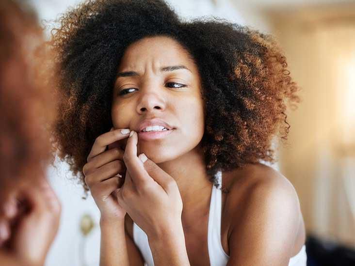 Getting rid of cold sores(Healthline)