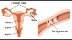 Blocked fallopian tube(YouTube)
