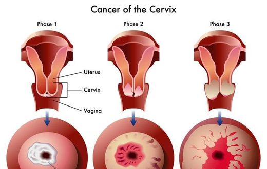 Stages of Cervical Cancer