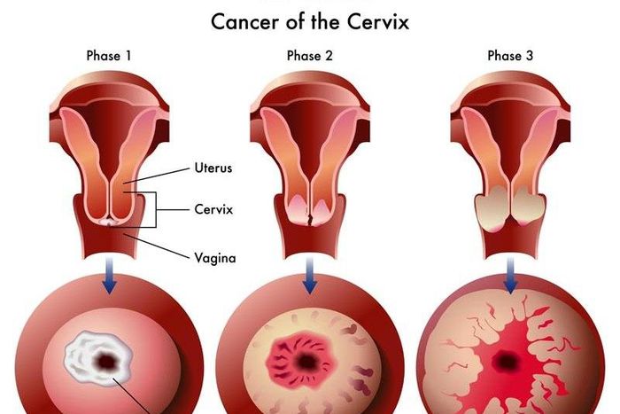 Stages of Cervical Cancer