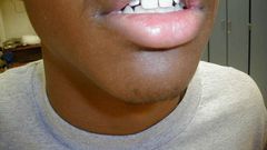 Cold sore(eagles eye)