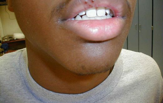 Cold sore(eagles eye)