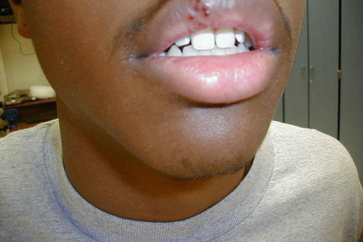 Cold sore(eagles eye)