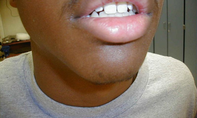 Cold sore(eagles eye)