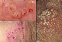 Symptoms of Genital herpes