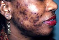 Bad case of adult acne(courtesy)
