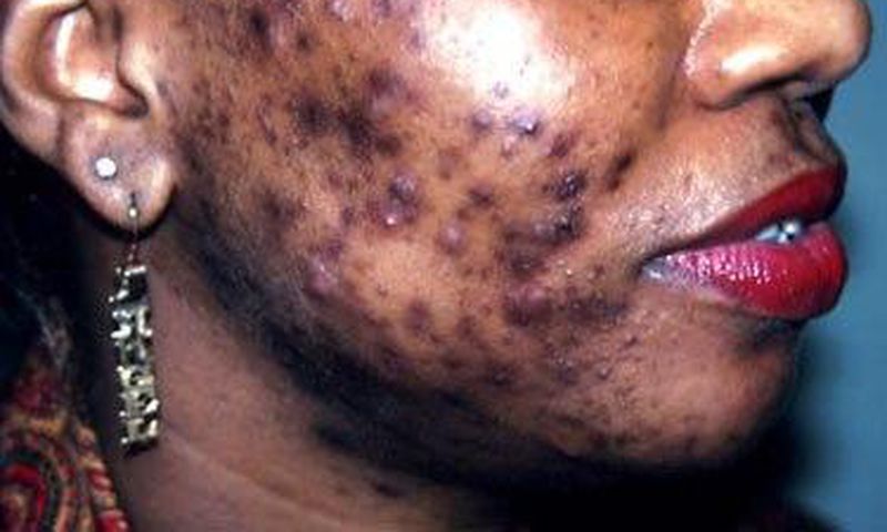 Bad case of adult acne