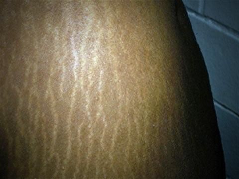 stretch marks