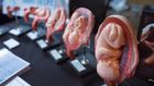 Unsafe abortions are rampant in Kenya