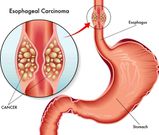 Esophageal-Cancer(peoplebeatingcancer)