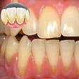 Tartar buildup (homeremediescare)