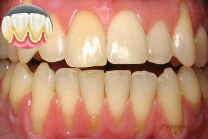 Tartar buildup (homeremediescare)