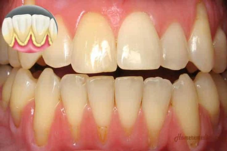 Tartar buildup (homeremediescare)