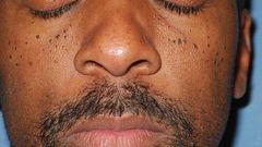 Moles(harcourthealth)