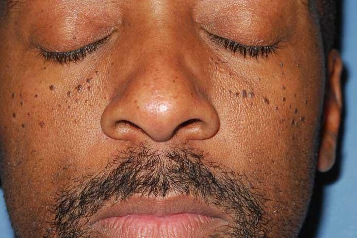 Moles(harcourthealth)