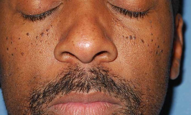 Moles(harcourthealth)