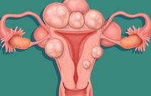 Uterine fibroids(courtesy)