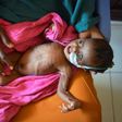 A severely malnourished child in the hands of her mother waits to be processed into a UNICEF- funded health programme catering to children displaced by drought, at the regional hospital in Baidoa town in south-western Somalia
