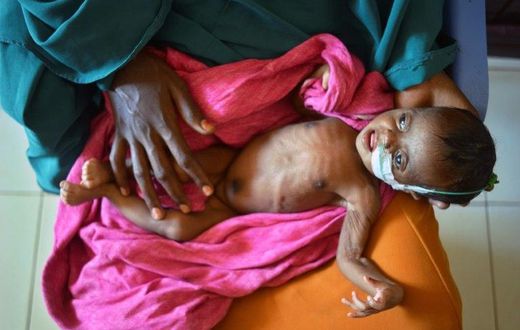 A severely malnourished child in the hands of her mother waits to be processed into a UNICEF- funded health programme catering to children displaced by drought, at the regional hospital in Baidoa town in south-western Somalia