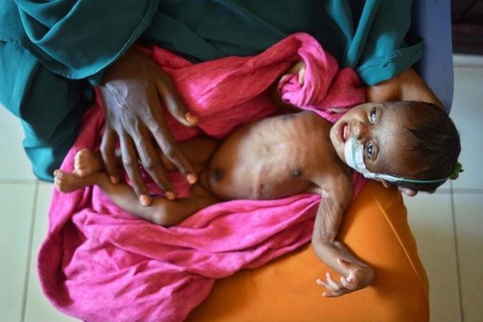A severely malnourished child in the hands of her mother waits to be processed into a UNICEF- funded health programme catering to children displaced by drought, at the regional hospital in Baidoa town in south-western Somalia