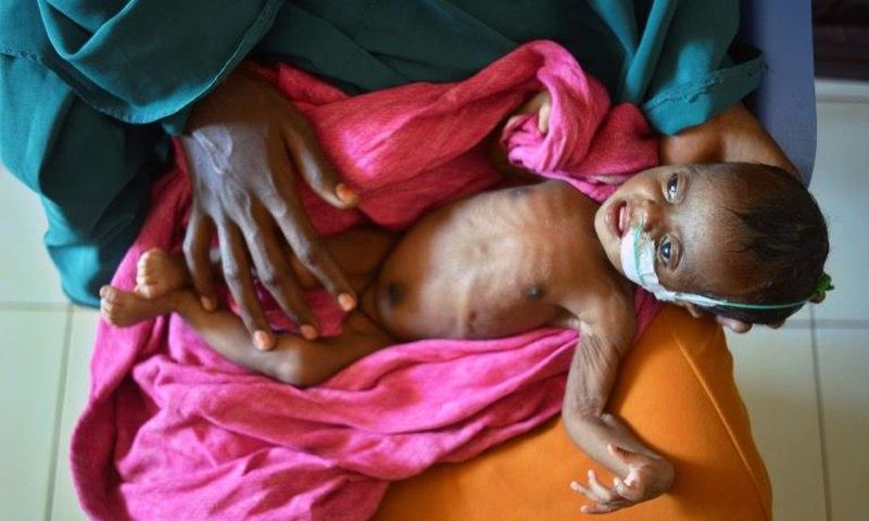 A severely malnourished child in the hands of her mother waits to be processed into a UNICEF- funded health programme catering to children displaced by drought, at the regional hospital in Baidoa town in south-western Somalia