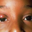 how to treat stye(North Texas Eye Center)