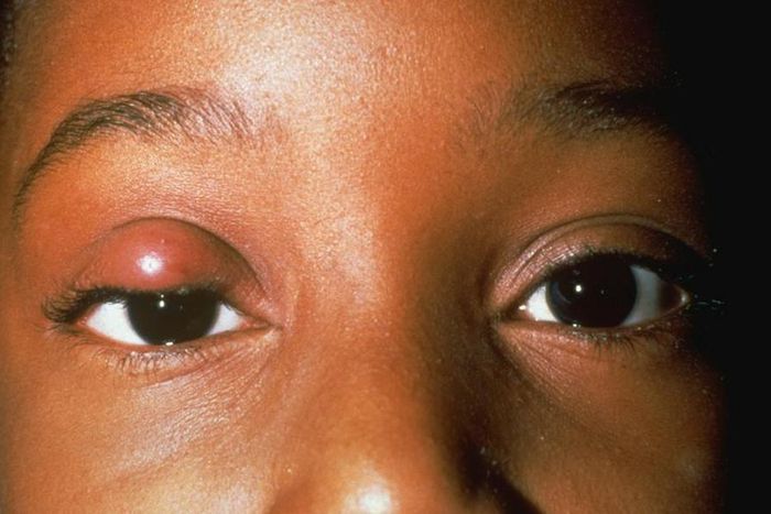 how to treat stye(North Texas Eye Center)