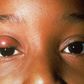 how to treat stye(North Texas Eye Center)
