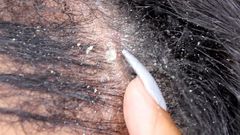 Causes of dandruff on your hair (YouTube)