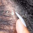 Causes of dandruff on your hair (YouTube)