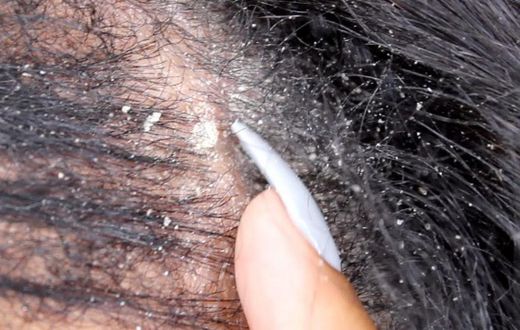 Causes of dandruff on your hair (YouTube)