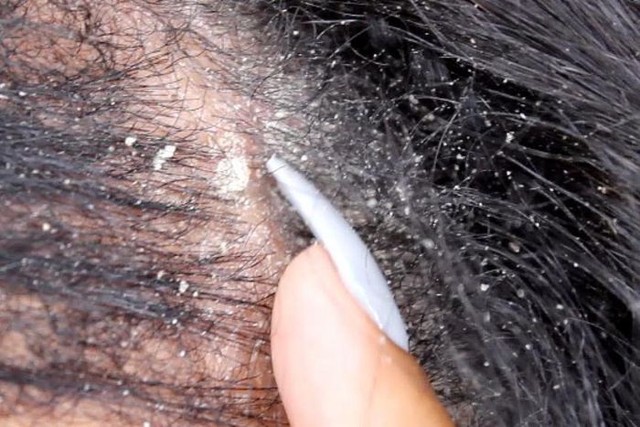 Causes of dandruff on your hair (YouTube)