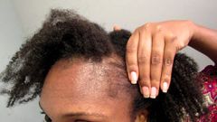Braids can finish your hairline