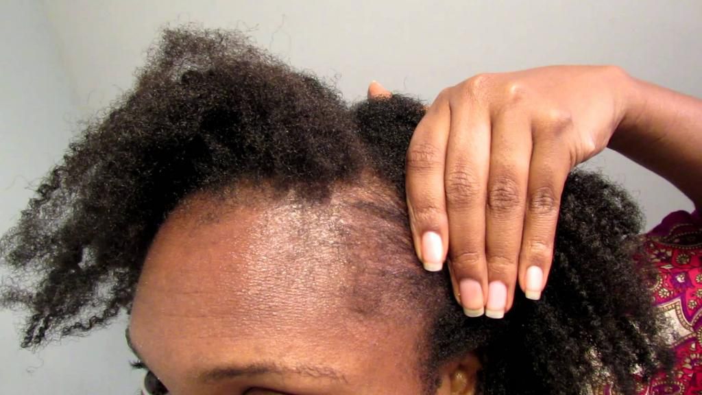 Braids can finish your hairline