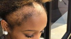 Hair loss(self)