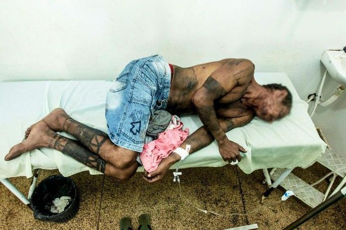 An indigenous Gamela man receives medical attention at a hospital in Viana, Brazil, on April 30, 2017, after being attacked by farmers